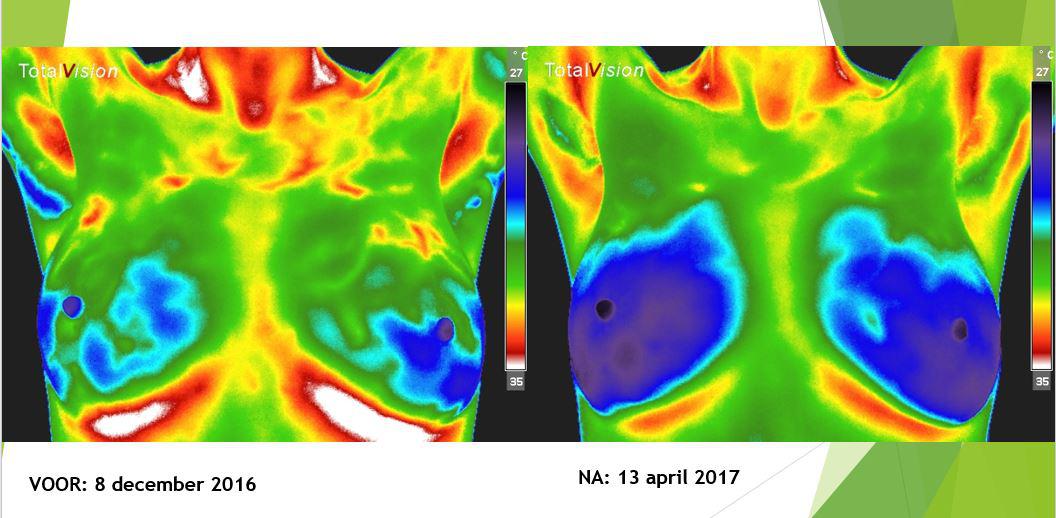 Wat is een Baseline in Medische Thermografie?