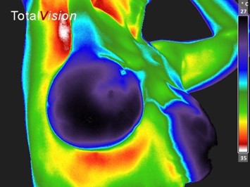 Borst implantaten, de voor- en nadelen